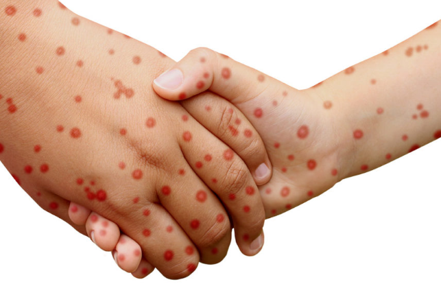 Dnevnik o cepljenju proti ošpicam